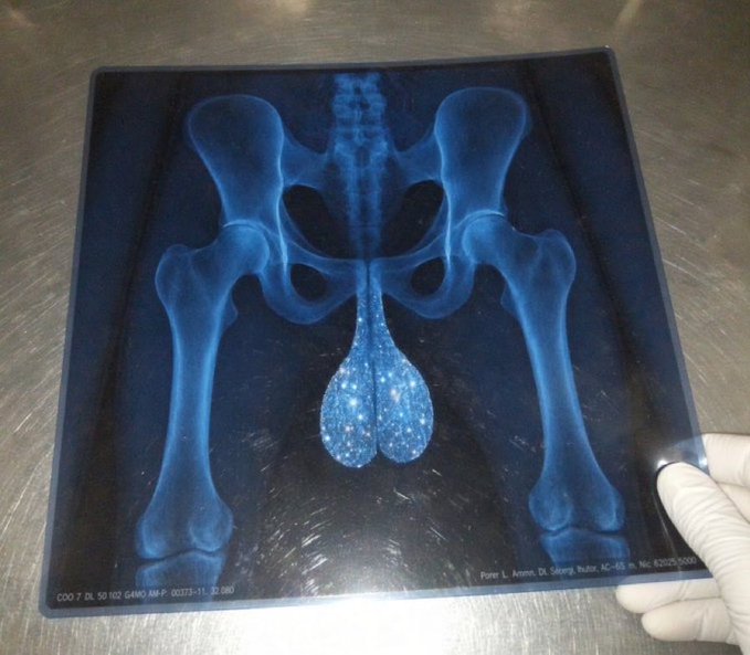 An X-ray image of a human pelvis displaying the testicles, held by a gloved hand, with diagnostic text reading "COO 7 DL 50 102 G4N0 IM P 00375-11 37.080" and "Peter L. Amato, D, Selorg, Nultze, AC-65 m. No: 620203020".