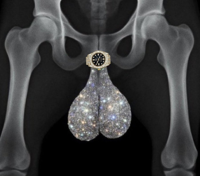 The image shows a black and white x-ray of someone's body, specifically their hips, with a gold watch attached to one of the hip bones. The watch has a gold band and face, adding an element of luxury or elegance to the scene. The x-ray is taken from the side view, providing a clear view of the person's hip bone and the watch on it.