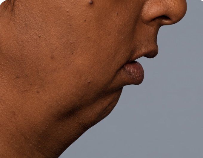 Close-up profile view of a person's lower face, showing the nose, lips, chin, and neck with a double chin against a gray background.