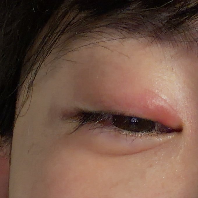 A close-up image of a person's eye showing signs of infection or inflammation, with a swollen, red, and irritated upper eyelid and crustiness along the lash line.