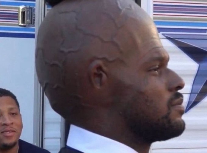 A man with a shaved head displaying prominent, raised vein patterns across his scalp is shown in profile, with another person partially visible in the background.
