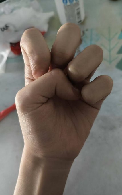 A close-up of a clenched fist with chipped and damaged fingernails.