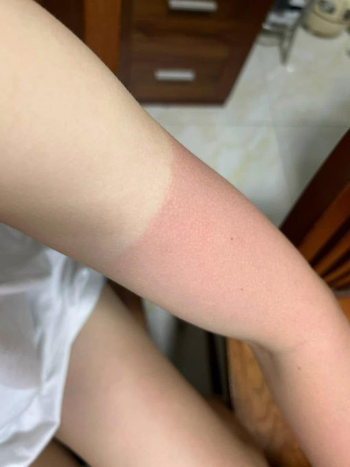 In the image, there is a person's arm that has been exposed to sunlight for an extended period of time, resulting in a sunburn. The skin appears red and burnt, indicating that the person has spent too much time outdoors without proper protection from the sun. This can be harmful to one's health as it increases the risk of skin damage and potential long-term effects such as premature aging or even skin cancer.