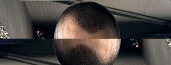 A composite image showing the top of a man's head with thinning hair and a visible bald spot, split horizontally. The image appears to be a meme expressing concern or alarm about Hyperliquid, likely reflecting anxiety or worry over the platform.