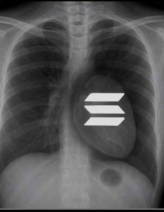 A black-and-white chest X-ray of a human torso with a white Solana (SOL) logo superimposed over the heart.