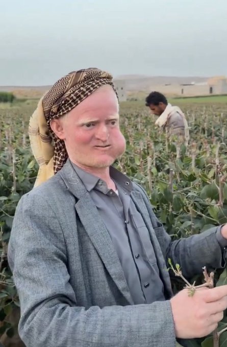 A man with distinctively swollen facial features wearing a traditional headscarf and grey jacket standing in a field, with another person visible in the background working among the crops.