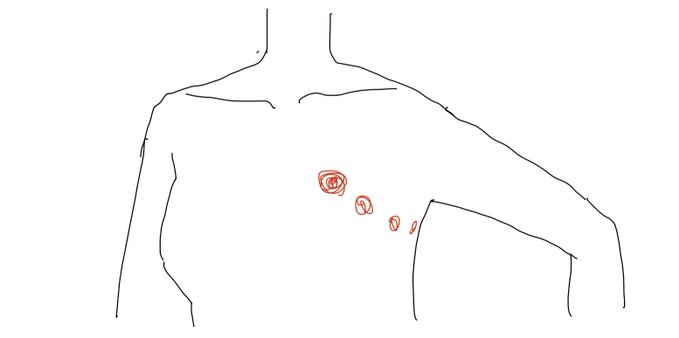 Simple line drawing sketch of a person's upper body/torso outline with small red scribbled marks indicating spots or wounds on the chest area.