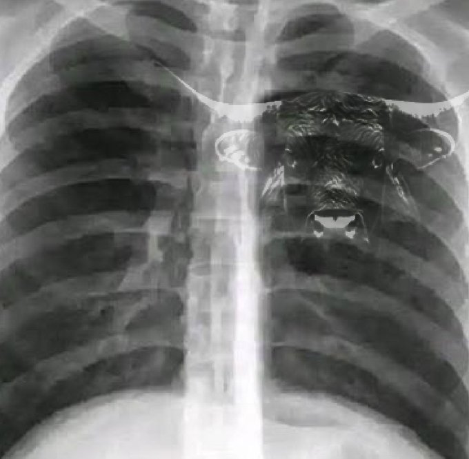 A chest X-ray image creatively edited to show a snarling gorilla's head superimposed over the upper left chest area, with the classic ribcage and spine visible.