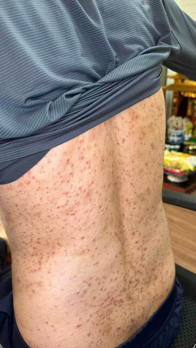A person's back is shown covered in widespread red, inflamed acne and breakouts. The poster is seeking advice on how to treat the severe back acne visible in the image.