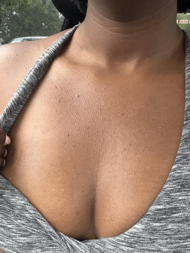 A close-up photo of a person's chest showing small, raised bumps across the skin, likely the texture they are asking about in relation to the "Hedera" appearance.

The image shows the upper chest and neck area with numerous tiny, uniform raised bumps (often called "chicken skin" or keratosis pilaris), which the poster is comparing to the texture seen in the r/Hedera subreddit.