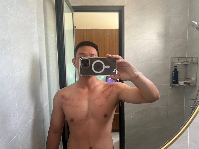 A shirtless man takes a mirror selfie in a bathroom, showing red marks or scratches across his chest.