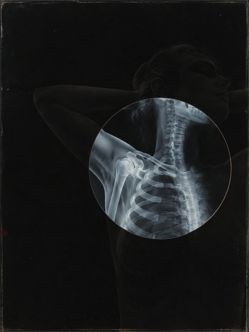An artistic X-ray composition featuring a circular window revealing the skeletal structure of a human ribcage, spine, and shoulder against a dark background.
