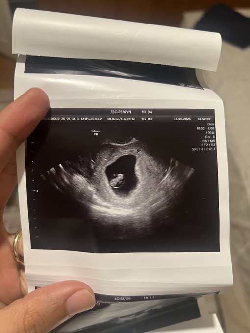 A hand holding an ultrasound printout dated 16.06.2026, with text visible including 'E8C-RS/GYN', '10.0cm/5.0MHz', and 'P6', showing an early gestational sac.