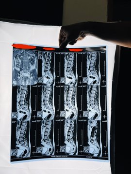 A hand pointing at a medical x-ray scan showing multiple cross-sectional views of a spine or pelvis.