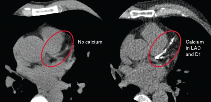 A medical imaging comparison showing two side-by-side CT scans with red circles highlighting areas labeled 'No calcium' on the left and 'Calcium in LAD and D1' on the right.