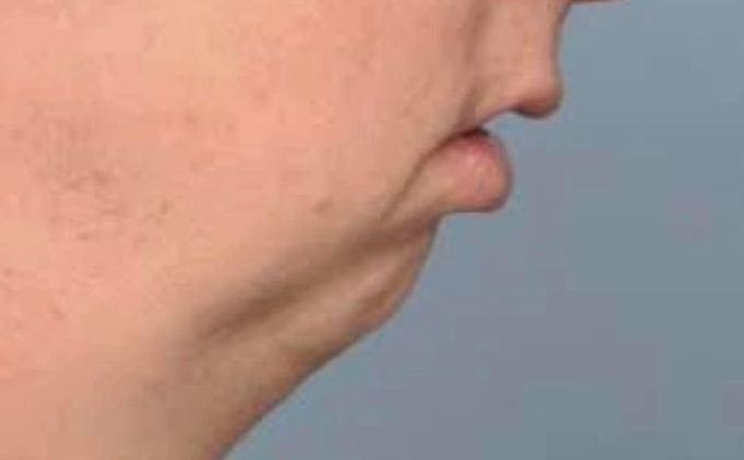 A close-up side-profile shot of a person's lower face, showing the chin, mouth, and neck area against a plain gray background.